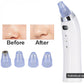 Bella Vita Blackhead Remover (White)