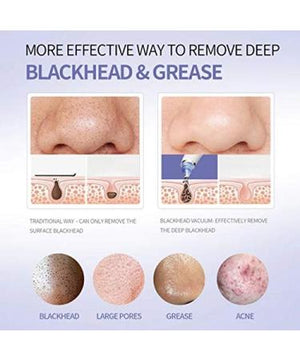 DermaSuction 4 in 1 Multi-function Blackhead Whitehead Extractor Remover